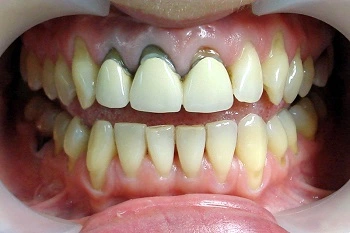 difetti estetici impianto con corona in metallo ceramica