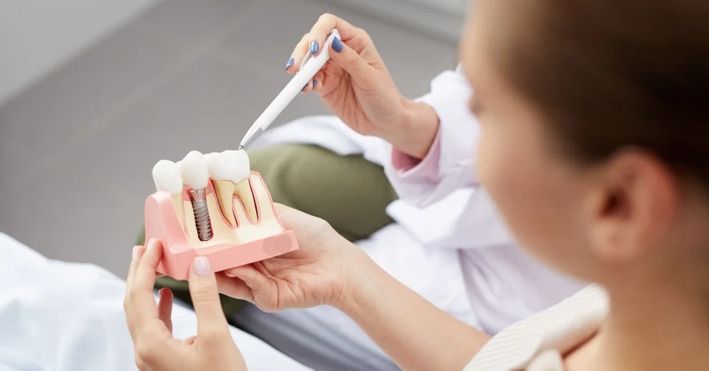 Impianti dentali: le domande più comuni