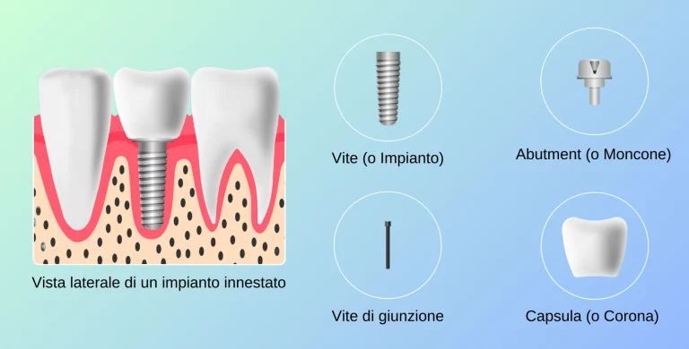 di cosa è composto un impianto dentale?