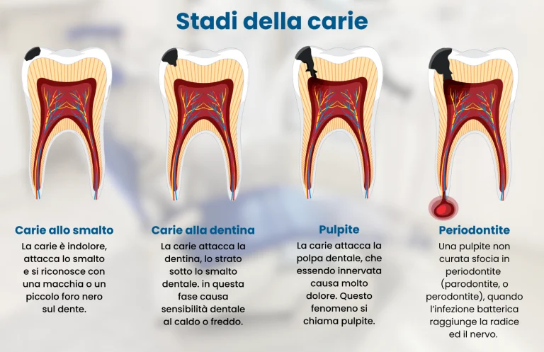 Stadi della carie - Centro Dentale del Sorriso